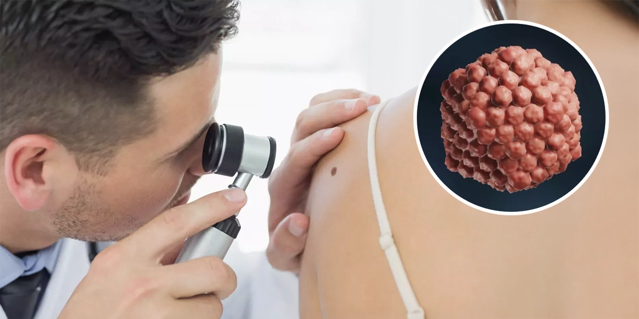 Un virus que combate el cáncer: cómo el herpes se convirtió en aliado de la medicina