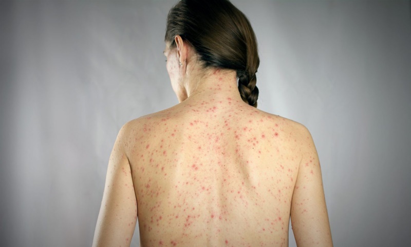 UNAM activa vigilancia por caso sospechoso de sarampión